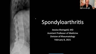 Spondyloarthritis