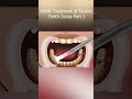SATISFYING ASMR ( TREATMENT OF SEVERE TOOTH DECAY) @Satisfying_ ASMR _Animations