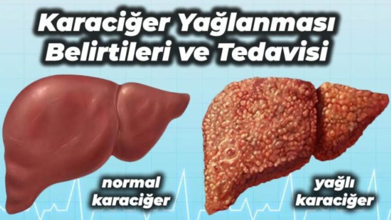 Karaciğer Yağlanmasında Ne Yapılmalı / Ne Yapılmamalı? ?⚕️ - YouTube