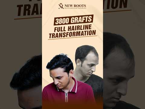 Hairline Restoration with 3800 Grafts | Hair Transplant in Kolkata | Bengali #hairtransplant #shorts