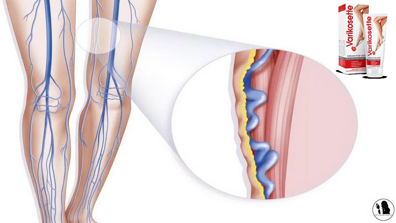 Varikosette Pomada Para Que Sirve