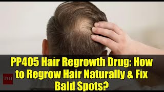 PP405 Hair Regrowth Drug: How to Regrow Hair Naturally & Fix Bald Spots?