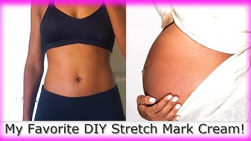 Prevent Stretch Marks Fast! | Most Effective DIY Stretch Mark Cream | Mom Tips 2018