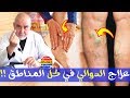 علاج الدوالي في كل المناطق طبيعيا بدون جراحة مع الدكتور كريم العابد العلوي (مجرب)