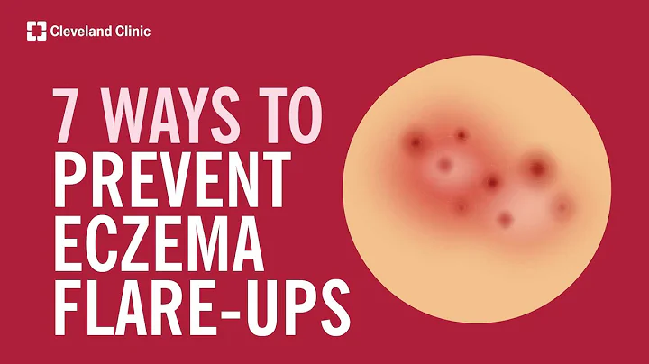 7 Ways to Prevent Eczema Flare-Ups