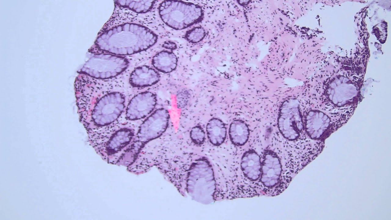 subtle neuroendocrine tumor in colon biopsy