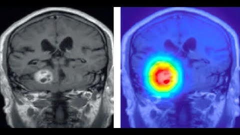 ASFNR Keynote 2025: A Guided Tour of AI in Neuroimaging