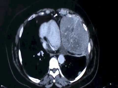 Vídeo: El Temut Tumor Cel·lular