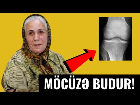 Video: Osteoartrit əlillik kimi təsnif edilə bilərmi?