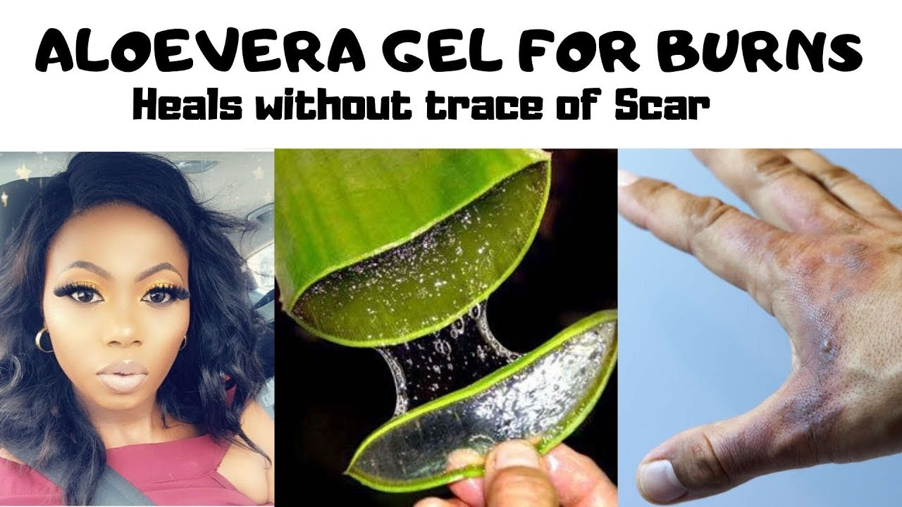 HEAL A BURN FAST WITH ALOE VERA PLANT GEL YouTube