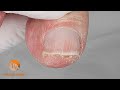 Extremely dry and inflexible skin | Nail clipping and excess skin removal in the medial grooves