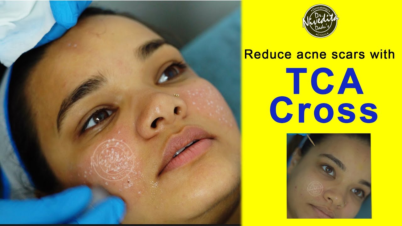 Reduce Acne Scars with TCA Cross Procedure Video YouTube