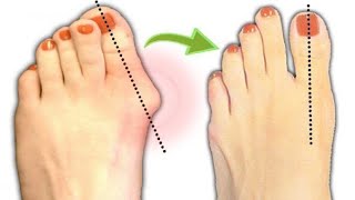 Практика для здоровья стоп #foot #healthy  #стопы #вальгус #профилактиказдоровья