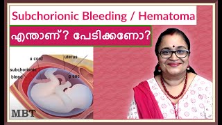 Subchorionic Hematoma/Bleeding In Pregnancy| What Is It |Should You Be Afraid|എന്താണ്|പേടിക്കണോ|MBT