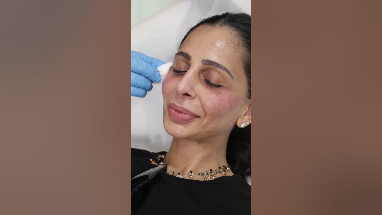 PRP SESSION FOR UNDER EYE DARK CIRCLES YouTube