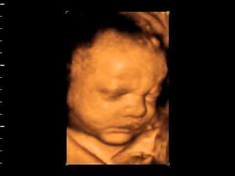 3d Baby scan from Genome Screening Services.avi