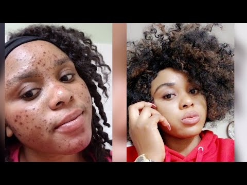 how-i-cleared-severe-acne-in-2weeks.-(quick-results)