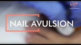 Ingrown toenail removal procedure | Infected ingrown toenail treatment | Nail Avulsion