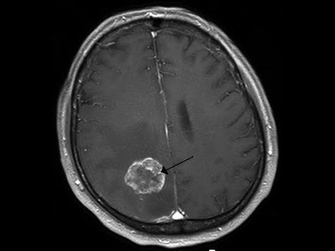 Vídeo: Los Científicos Han Programado La Salmonela Para Devorar Tumores Cerebrales - Vista Alternativa