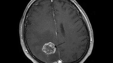 ¿Puede un TAC provocar un tumor cerebral?