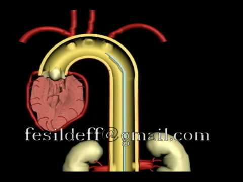 Video: Aortna Stenoza In Stenoza Srčnega Ventila