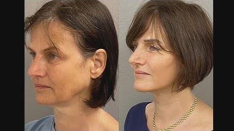 Everything you need to know about the facelift process
