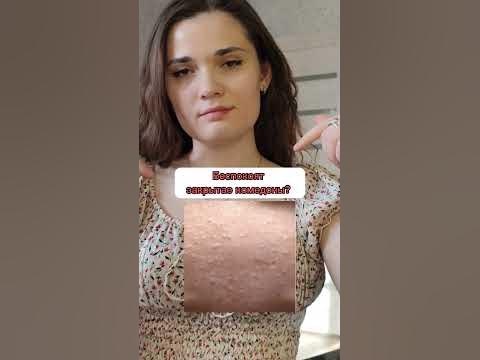 Закрытые комедоны - YouTube