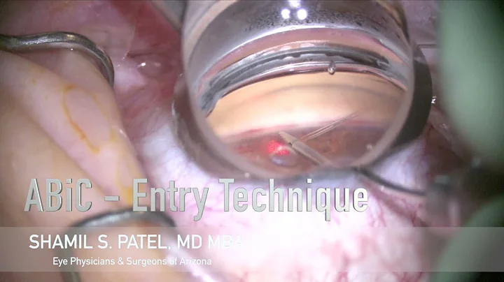 ABiC (Ab Interno Canaloplasty) showing RPT (Reiss-Patel Technique)