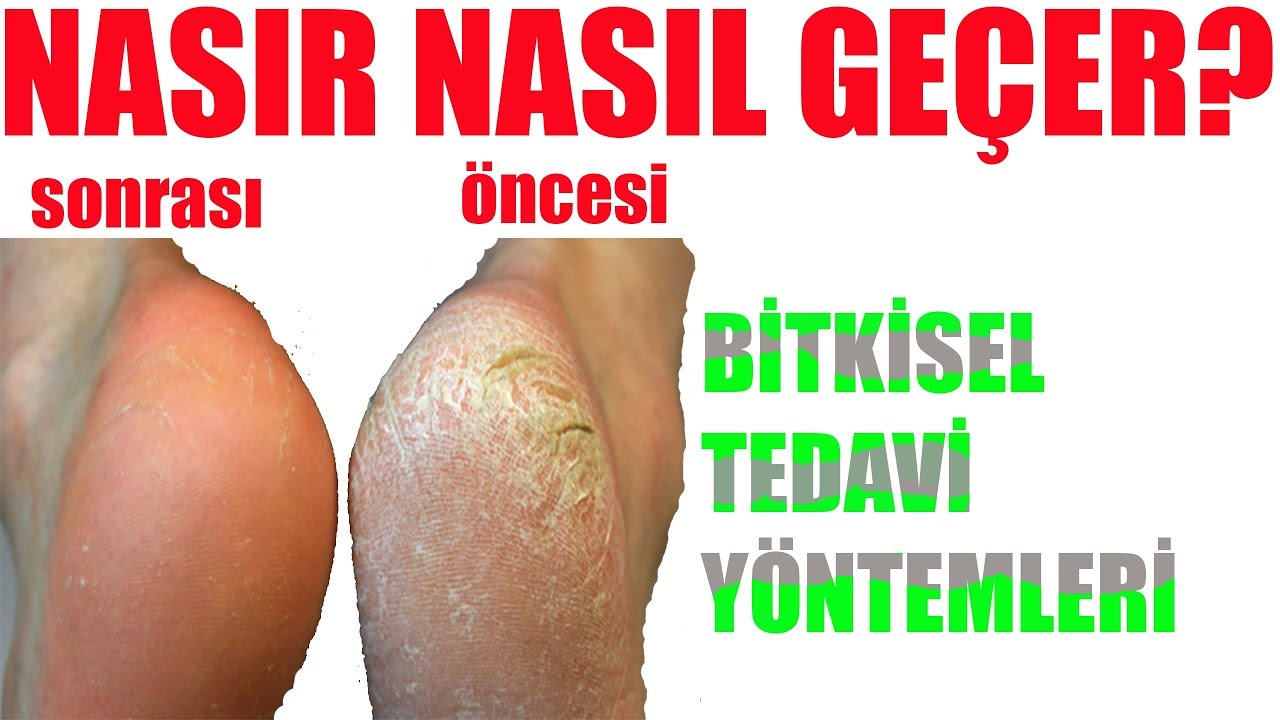 Nasırı 1 Günde Geçirecek Tedavi Nasırı 1 Günde Geçirecek Tedavi