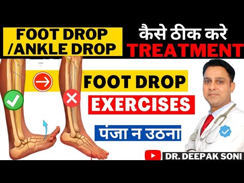 Foot drop kaise theek kare | लकवे के बाद पंजा नही उठने का ट्रीटमेंट | How to treat Foot Drop | Hindi