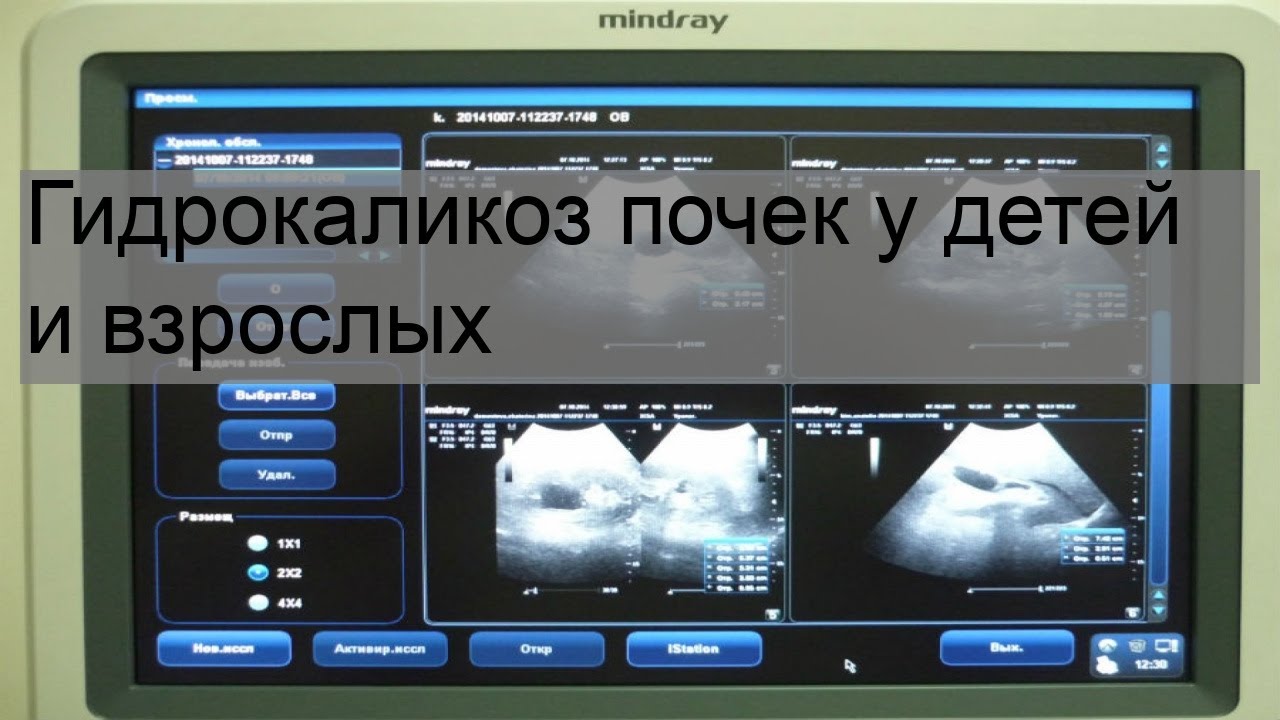 Гидрокаликоз почек у детей и взрослых