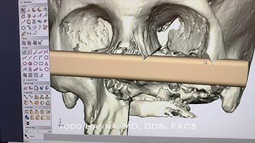 Rebuilding.. Maxillectomy Fibula Free Flap Recon