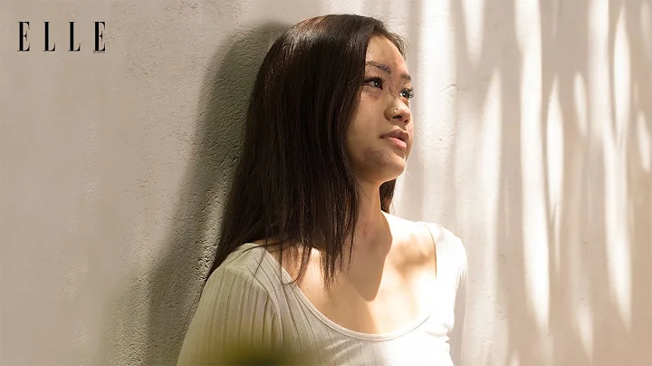 Charlene Chew, Burn Survivor, On Beauty As A Form ...