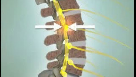 IBS Hospital | Conquering Severe Back Pain: Disc Herniation & Spinal Stenosis Recovery