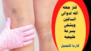 دهنة واحده قبل النوم هتخلصك من دوالى الساقين والاورده العنكبوتيه نهائيا بدون جراحه