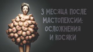 3 МЕСЯЦА ПОСЛЕ МАММОПЛАСТИКИ И МАСТОПЕКСИИ: осложнения и косяки