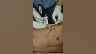 Pull out WSD buka perban gunting benang,tarik selang WSD,pasien tarik napas dan tahan,ikat benang