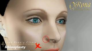 Rhinoplasty Animation - عملية تجميل الأنف وتصغير فتحات الأنف