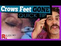 CROWS FEET GONE // Botox for Crows Feet