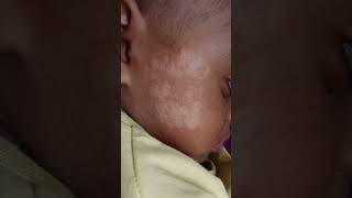#ringworm#tinea#homeopathy,complete cure from recurrent fungal infection with homeopathy.Thank you🙏🏻