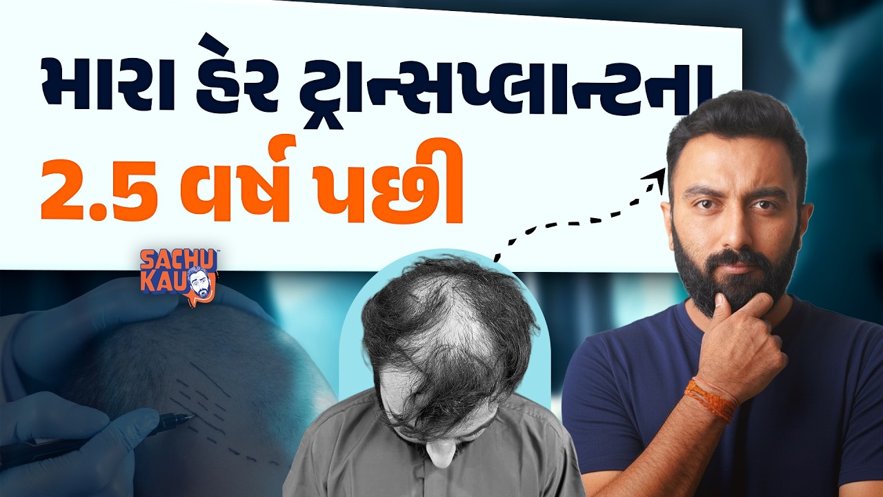 My Hair Transplant Journey | 2.5 વર્ષ પછી, શું હું મારા હેર ટ્રાન્સપ્લાન્ટથી ખુશ છું? | Sachu Kau