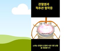 관절염과 척추 신경통