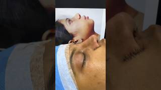 Best Before and After Nose Re Contouring female rhinoplasty plasticsurgery in India