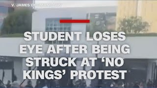 Student loses eye after being struck at 'No Kings' protest in California