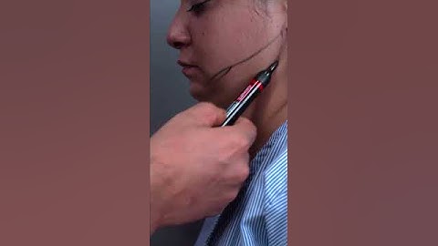 Chin Liposuction and Buccal Fat Removal