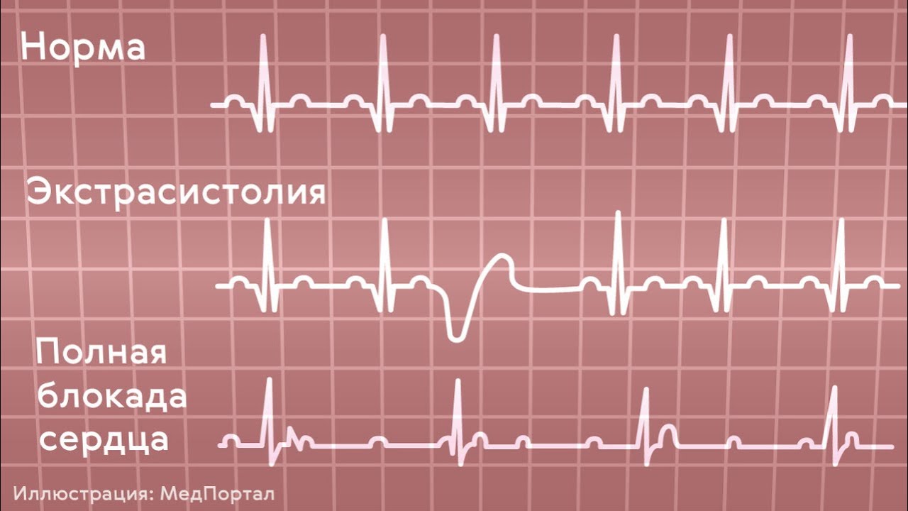 Экстрасистолы много. Сердце,экстрасистолы, аритмия. Экстрасистолия клиника ЭКГ- признаки. Экстрасистолы на ЭКГ. Предсердные экстрасистолы на ЭКГ.