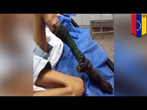 Binti ng babae, nangitim at nabulok dahil sa kagat ng ahas! Binti ng babae, nangitim at nabulok dahil sa kagat ng ahas!