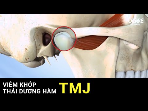 Bệnh rối loạn khớp thái dương hàm (TMJ) gây đau quai hàm