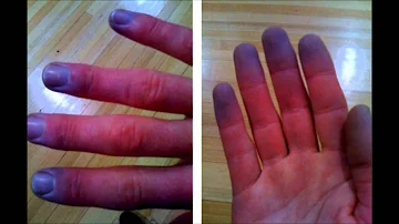 Come far passare la sindrome di Raynaud?