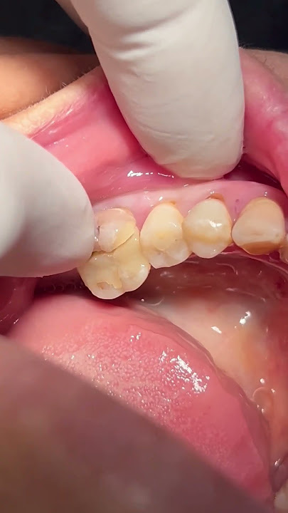 Fracture of root canal treated tooth #dentist